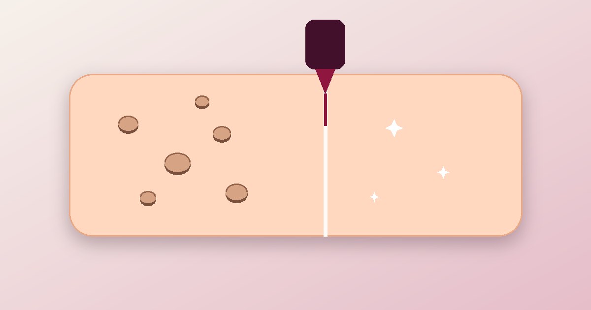 Can Acne Scars Be Removed Permanently? An Honest Answer