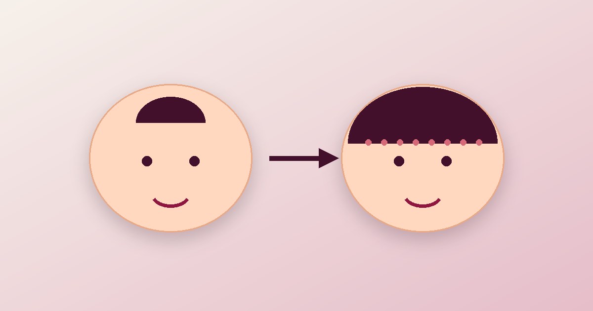 Hair Transplant in Your 20s, 30s or 40s: When Is the Right Time?