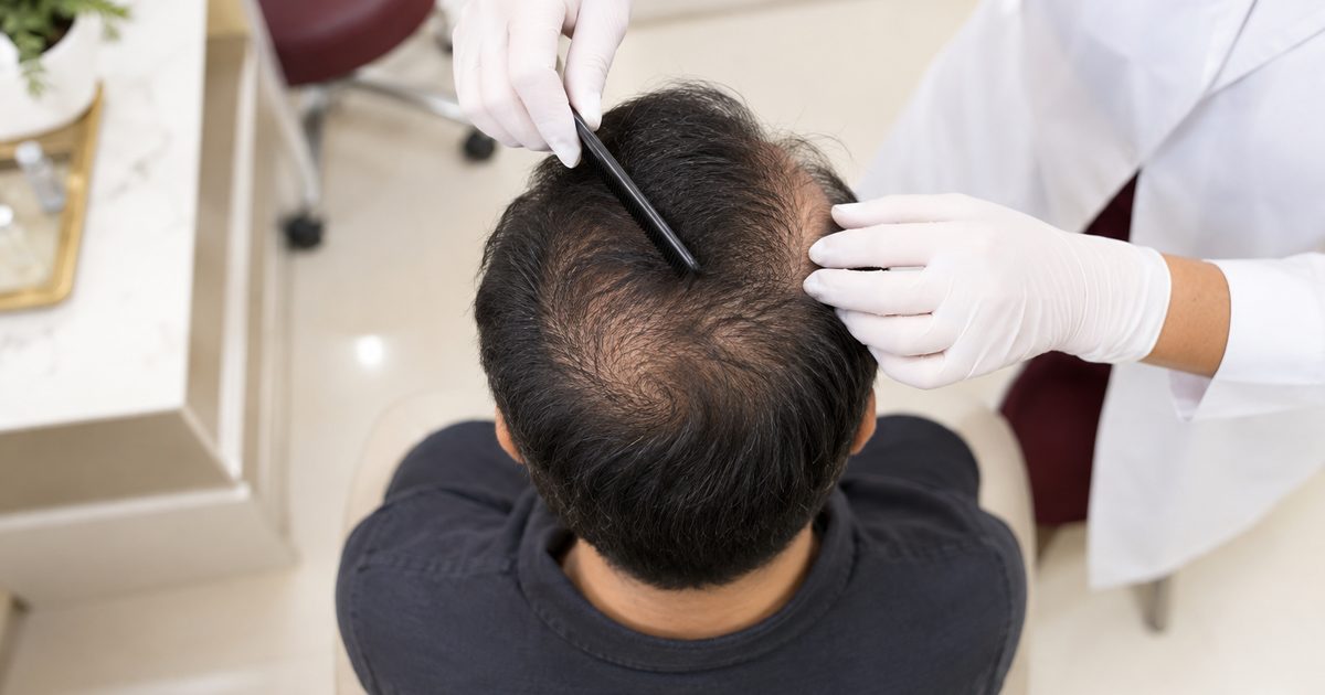 Male Pattern Baldness Treatment: What Works at Each Stage