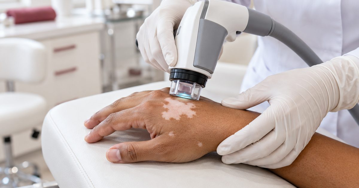 Can Vitiligo Be Treated? Excimer Laser, Phototherapy and Grafting Explained